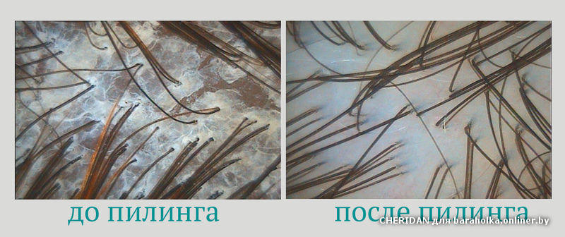 Пилинг для кожи головы