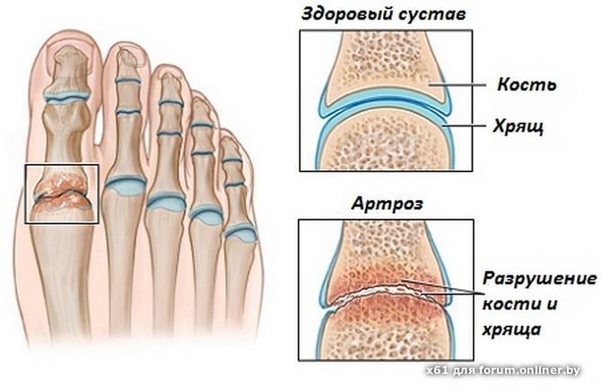 Как сделать артроз 2 степени Артроз причины, симптомы, осложнения и методы лечения