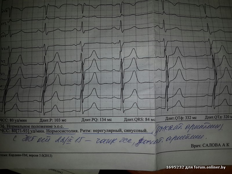 правильный синусовый ритм на экг. заключение по экг синусовый ритм. синусовая мерцательная аритмия экг. ритм синусовый нерегулярный. синусовый ритм регулярный ритм экг.