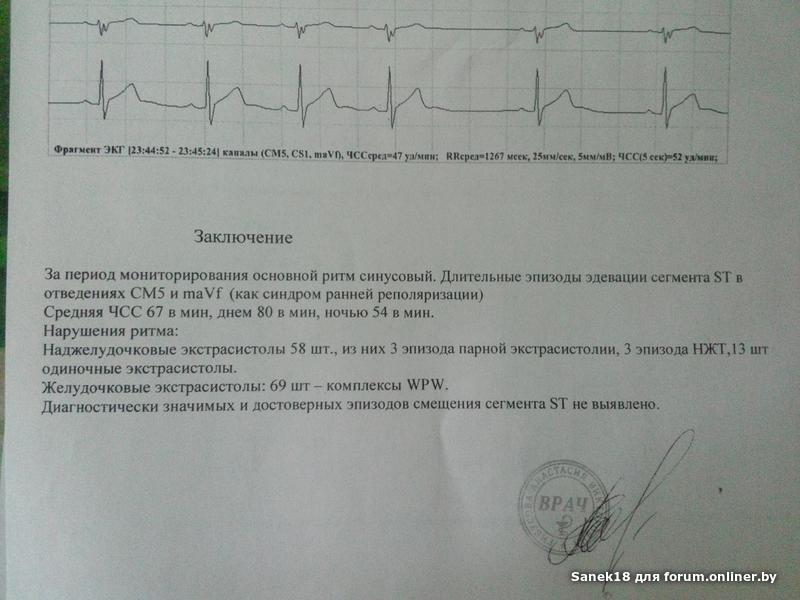 Образец заключения экг