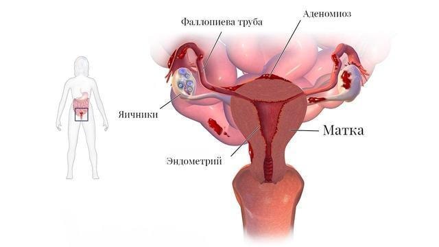 Боль во время менструации: причины и способы улучшения состояния