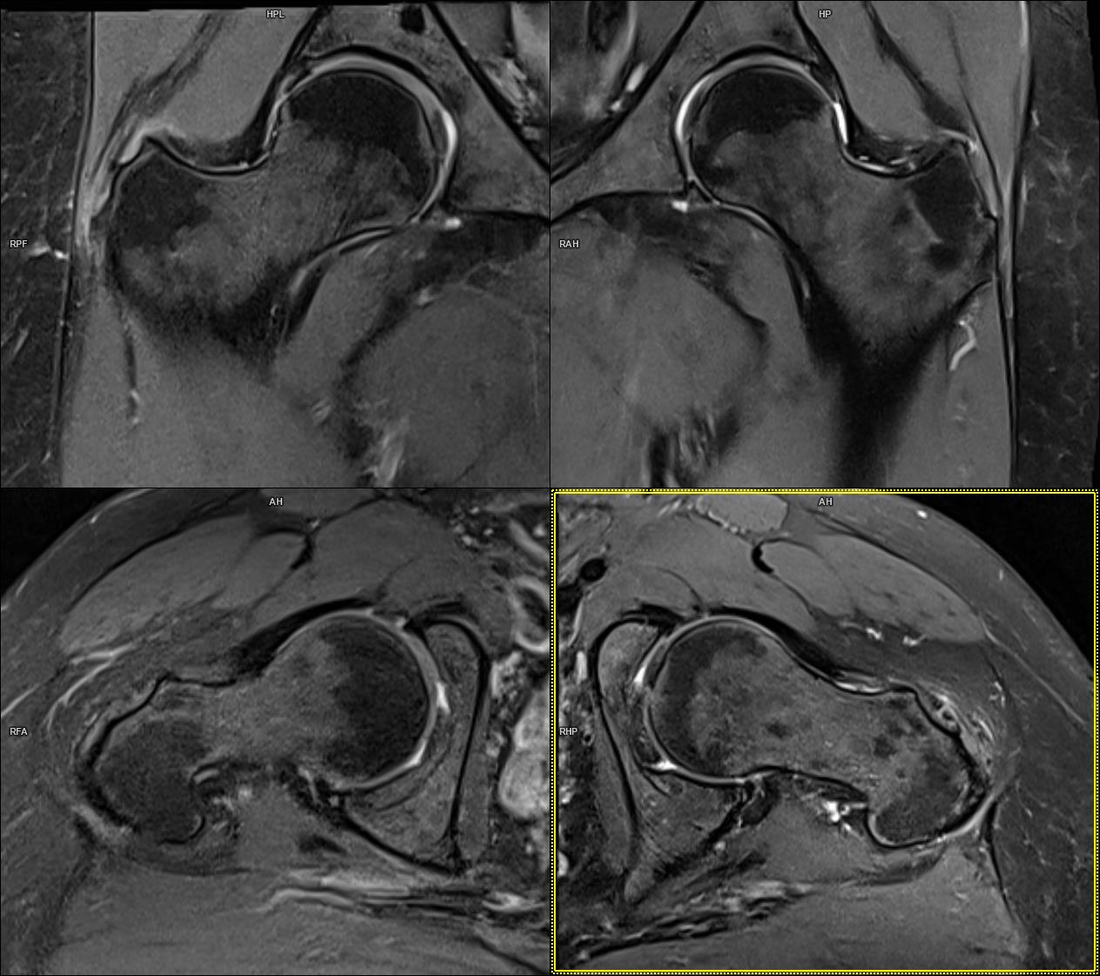 Что покажет мрт тазобедренного сустава у женщин. Трохантерит тазобедренного мрт. Трохантерит тазобедренного сустава мрт. Коксартроз тазобедренного сустава мрт.