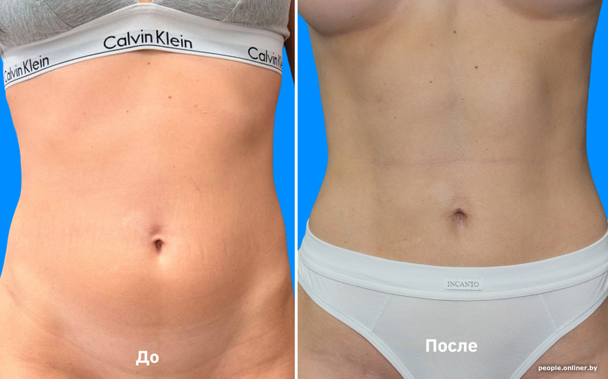 Как белорусы делают липосакцию