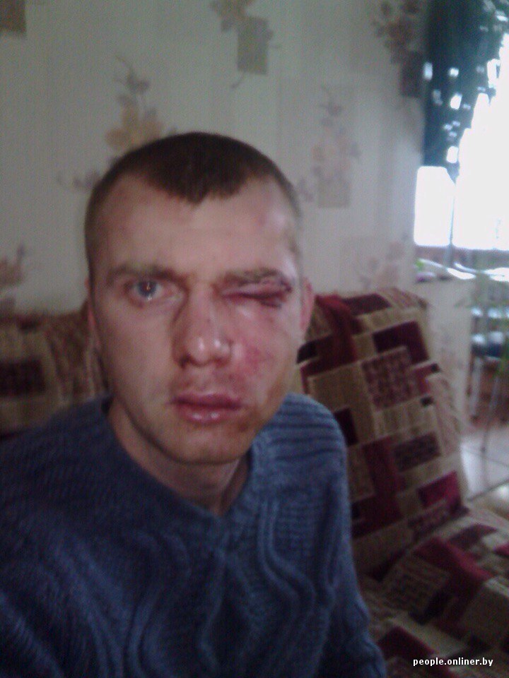 Актриса Наталья Рудова опубликовала фото разбитого лица
