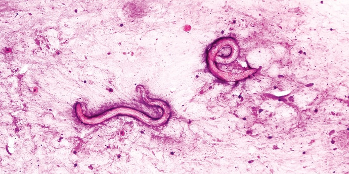 ドナーの腎臓は、「寄生虫」の2人のアメリカ人の感染と呼ばれていました