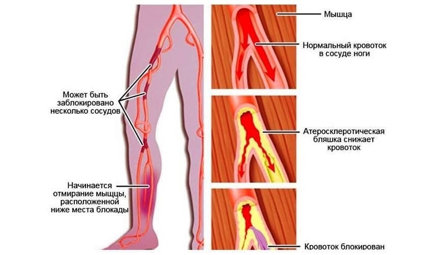Сужение правой артерии. Облитерирующий атеросклероз симптомы. Облитерирующий атеросклероз нижних конечностей. Облитерирующий атеросклероз артерий конечности. Атеросклероз артерий нижних конечностей факторы.